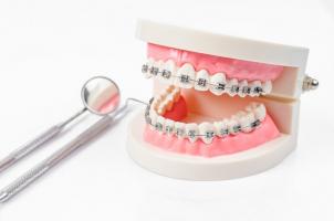 Địa chỉ niềng răng uy tín nhất tỉnh Lạng Sơn