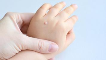 Mẹo trị mụn cóc đơn giản tại nhà