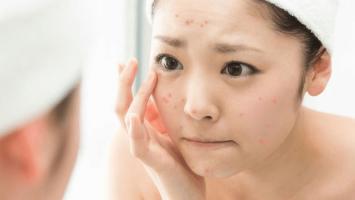 Địa chỉ nặn mụn chuẩn y khoa ở Quy Nhơn, Bình Định nổi tiếng nhất