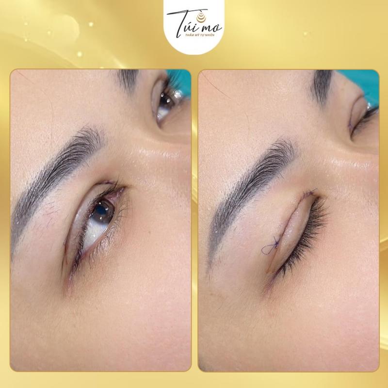 Túi Mơ - Thẩm mỹ tự nhiên