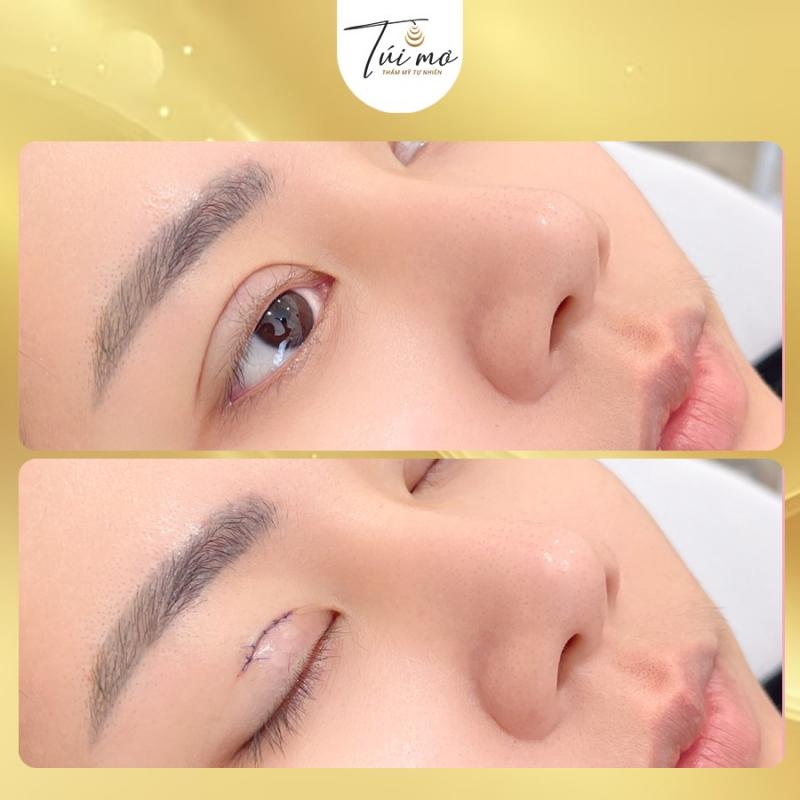 Túi Mơ - Thẩm mỹ tự nhiên